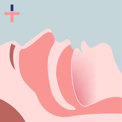 Obstructive Sleep Apnoea breathing pauses an example of what choking while sleeping looks like.