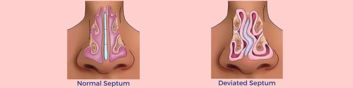 Nasal pillows deviated septum outlet
