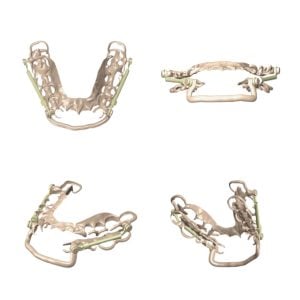 Somnowell Chrome Dentist Made Mandibular Advancement Device | Intus Healthcare